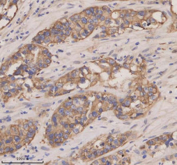 Immunohistochemical staining of CXCL13 using anti-CXCL13 antibody. CXCL13 was detected in a paraffin-embedded section of human appendiceal adenocarcinoma tissue. Heat mediated antigen retrieval was performed in EDTA buffer (pH 8.0, epitope retrieval solution). The tissue section was blocked with 10% goat serum. The tissue section was then incubated with 2 ug/ml rabbit anti-CXCL13 antibody overnight at 4oC.