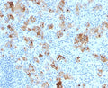 IHC testing of formalin-fixed, paraffin-embedded human Hodgkin's lymphoma stained with CD30 antibody (clone SPM121).