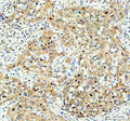 Immunohistochemical staining of SRARP using anti-SRARP antibody. SRARP was detected in a paraffin-embedded section of human bladder cancer tissue. Heat mediated antigen retrieval was performed in EDTA buffer (pH 8.0, epitope retrieval solution). The tissue section was blocked with 10% goat serum. The tissue section was then incubated with 2 ug/ml rabbit anti-SRARP antibody overnight at 4oC. Peroxidase Conjugated Goat Anti-rabbit IgG was used as secondary antibody and incubated for 30 min at 37oC.