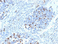 IHC staining of FFPE human lung carcinoma with recombinant p21 antibody (clone CIP1/4377R). HIER: boil tissue sections in pH 9 10mM Tris with 1mM EDTA for 20 min and allow to cool before testing.