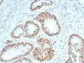 IHC staining of FFPE human colon carcinoma tissue with SATB2 antibody (clone SATB2/7110). Strong nuclear staining is observed at 2ug/ml. HIER: boil tissue sections in pH 9 10mM Tris with 1mM EDTA for 20 min and allow to cool before testing.