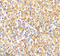 Immunohistochemical staining of NUDT7 using anti-NUDT7 antibody. NUDT7 was detected in a paraffin-embedded section of human liver cancer tissue. Heat mediated antigen retrieval was performed in EDTA buffer (pH 8.0, epitope retrieval solution). The tissue section was blocked with 10% goat serum. The tissue section was then incubated with 2 ug/ml rabbit anti-NUDT7 antibody overnight at 4oC. Peroxidase Conjugated Goat Anti-rabbit IgG was used as secondary antibody and incubated for 30 min at 37oC.