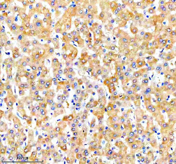 Immunohistochemical staining of NUDT7 using anti-NUDT7 antibody. NUDT7 was detected in a paraffin-embedded section of human liver cancer tissue. Heat mediated antigen retrieval was performed in EDTA buffer (pH 8.0, epitope retrieval solution). The tissue section was blocked with 10% goat serum. The tissue section was then incubated with 2 ug/ml rabbit anti-NUDT7 antibody overnight at 4oC. Peroxidase Conjugated Goat Anti-rabbit IgG was used as secondary antibody and incubated for 30 min at 37oC.