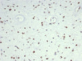 IHC staining of FFPE human rhabdomyosarcoma tissue with MyoD1 antibody (clone MYOD1/7149). HIER: boil tissue sections in pH 9 10mM Tris with 1mM EDTA for 20 min and allow to cool before testing.