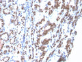 IHC: Formalin-fixed, paraffin-embedded human thyroid stained with recombinant TTF-1 antibody (clone rNX2.1/690). Required HIER: boil tissue sections in pH6, 10mM citrate buffer, for 10-20 min followed by cooling at RT for 20 min.