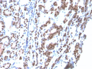 IHC: Formalin-fixed, paraffin-embedded human thyroid stained with recombinant TTF-1 antibody (clone rNX2.1/690). Required HIER: boil tissue sections in pH6, 10mM citrate buffer, for 10-20 min followed by cooling at RT for 20 min.