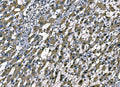 IHC staining of FFPE human liver cancer tissue with Superoxide Dismutase 2 antibody. HIER: boil tissue sections in pH8 EDTA for 20 min and allow to cool before testing.