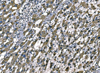 IHC staining of FFPE human liver cancer tissue with Superoxide Dismutase 2 antibody. HIER: boil tissue sections in pH8 EDTA for 20 min and allow to cool before testing.