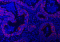 Immunofluorescent staining of FFPE human colorectal adenocarcinoma tissue with TRAM1L1 antibody (red) and DAPI nuclear stain (blue). HIER: steam section in pH8 EDTA buffer for 20 min.