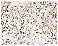 IHC staining of FFPE human glioma tissue with VCP antibody. HIER: boil tissue sections in pH8 EDTA for 20 min and allow to cool before testing.