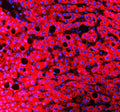 Immunofluorescent staining of FFPE human liver cancer tissue with RBP4 antibody (red) and DAPI nuclear stain (blue). HIER: steam section in pH8 EDTA buffer for 20 min.