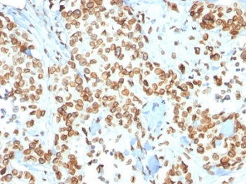 IHC testing of FFPE human breast carcinoma with Emerin antibody (clone EMD/2167). Required HIER: boiling tissue sections in 10mM citrate buffer, pH 6, for 10-20 min and allow to cool prior to staining.