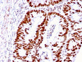 IHC staining of FFPE human colon carcinoma with MSH6 antibody. HIER: boil tissue sections in pH 9 10mM Tris with 1mM EDTA for 10-20 min and allow to cool before testing.