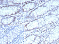 IHC staining of FFPE human colon carcinoma tissue with Cyclin-dependent kinase 4 antibody (clone CDK4/8896). Inset: PBS used in place of primary Ab (secondary Ab negative control). HIER: boil tissue sections in pH 9 10mM Tris with 1mM EDTA for 20 min and allow to cool before testing.