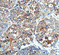Immunohistochemical staining of HERC4 using anti-HERC4 antibody. HERC4 was detected in a paraffin-embedded section of human liver cancer tissue. Heat mediated antigen retrieval was performed in EDTA buffer (pH 8.0, epitope retrieval solution). The tissue section was blocked with 10% goat serum. The tissue section was then incubated with 2 ug/ml rabbit anti-HERC4 antibody overnight at 4oC. Peroxidase Conjugated Goat Anti-rabbit IgG was used as secondary antibody and incubated for 30 min at 37oC.