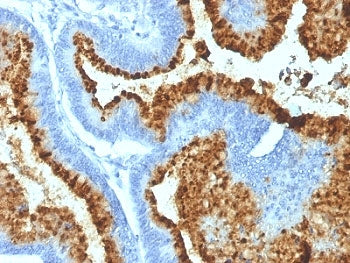 IHC: Formalin-fixed, paraffin-embedded human colon carcinoma stained with Blood Group B antibody (HEB-20).