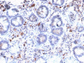 IHC staining of FFPE human gastric carcinoma with MUC3 antibody. HIER: boil tissue sections in 10mM Tris with 1mM EDTA, pH 9, for 10-20 min and allow to cool before testing.