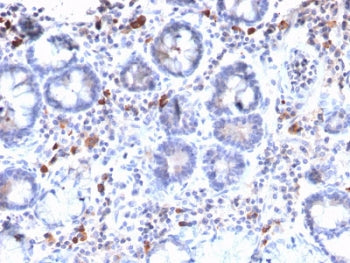 IHC staining of FFPE human gastric carcinoma with MUC3 antibody. HIER: boil tissue sections in 10mM Tris with 1mM EDTA, pH 9, for 10-20 min and allow to cool before testing.