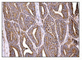 IHC staining of FFPE human rectal cancer tissue with Holocytochrome c-type synthase antibody. HIER: boil tissue sections in pH8 EDTA for 20 min and allow to cool before testing.