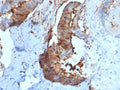 IHC testing of FFPE human renal cell carcinoma with Cathepsin D antibody (clone CTSD/2781). HIER: boil tissue sections in pH6, 10mM citrate buffer, for 10-20 min followed by cooling at RT for 20 min.