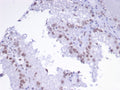 IHC staining of FFPE human renal cell carcinoma tissue with TFAP2A antibody (clone PCRP-TFAP2A-2C2). HIER: boil tissue sections in pH 9 10mM Tris with 1mM EDTA for 20 min and allow to cool before testing.