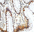 Immunohistochemical staining of NAV1 using anti-NAV1 antibody. NAV1 was detected in a paraffin-embedded section of human breast cancer tissue. Heat mediated antigen retrieval was performed in EDTA buffer (pH 8.0, epitope retrieval solution). The tissue section was blocked with 10% goat serum. The tissue section was then incubated with 2 ug/ml rabbit anti-NAV1 antibody overnight at 4oC. Peroxidase Conjugated Goat Anti-rabbit IgG was used as secondary antibody and incubated for 30 min at 37oC.