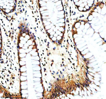 Immunohistochemical staining of NAV1 using anti-NAV1 antibody. NAV1 was detected in a paraffin-embedded section of human breast cancer tissue. Heat mediated antigen retrieval was performed in EDTA buffer (pH 8.0, epitope retrieval solution). The tissue section was blocked with 10% goat serum. The tissue section was then incubated with 2 ug/ml rabbit anti-NAV1 antibody overnight at 4oC. Peroxidase Conjugated Goat Anti-rabbit IgG was used as secondary antibody and incubated for 30 min at 37oC.