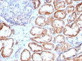 IHC: Formalin-fixed, paraffin-embedded human renal cell carcinoma stained with HSP60 antibody (clone HSPD1/780).