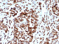 IHC staining of FFPE human ovarian cancer tissue with MDM2 antibody (clone MDM2/7942). HIER: boil tissue sections in pH 9 10mM Tris with 1mM EDTA for 20 min and allow to cool before testing.