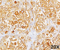 Formalin/paraffin human melanoma stained with MART-1 / Melan-A antibody (clone M2-9E3). Note cytoplasmic staining of cells.