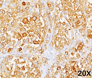 Formalin/paraffin human melanoma stained with MART-1 / Melan-A antibody (clone M2-9E3). Note cytoplasmic staining of cells.
