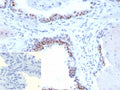 IHC staining of FFPE human prostate carcinoma tissue with recombinant Androgen Receptor V7 antibody (clone DHTR.V7/9394R). HIER: boil tissue sections in pH 9 10mM Tris with 1mM EDTA for 20 min and allow to cool before testing.