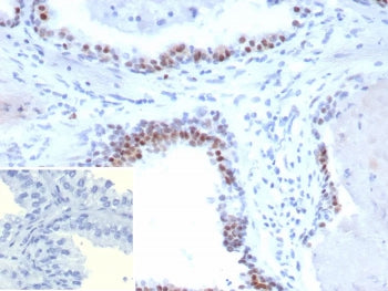 IHC staining of FFPE human prostate carcinoma tissue with recombinant Androgen Receptor V7 antibody (clone DHTR.V7/9394R). HIER: boil tissue sections in pH 9 10mM Tris with 1mM EDTA for 20 min and allow to cool before testing.