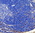 IHC analysis of FUBP1 using anti-FUBP1 antibody. FUBP1 was detected in a paraffin-embedded section of human breast cancer tissue. Heat mediated antigen retrieval was performed in EDTA buffer (pH 8.0, epitope retrieval solution). The tissue section was blocked with 10% goat serum. The tissue section was then incubated with 2 ug/ml rabbit anti-FUBP1 antibody overnight at 4oC. Peroxidase Conjugated Goat Anti-rabbit IgG was used as secondary antibody and incubated for 30 min at 37oC.