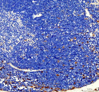 IHC analysis of FUBP1 using anti-FUBP1 antibody. FUBP1 was detected in a paraffin-embedded section of human breast cancer tissue. Heat mediated antigen retrieval was performed in EDTA buffer (pH 8.0, epitope retrieval solution). The tissue section was blocked with 10% goat serum. The tissue section was then incubated with 2 ug/ml rabbit anti-FUBP1 antibody overnight at 4oC. Peroxidase Conjugated Goat Anti-rabbit IgG was used as secondary antibody and incubated for 30 min at 37oC.