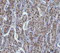 IHC staining of FFPE human liver cancer tissue with KMO antibody. HIER: boil tissue sections in pH8 EDTA for 20 min and allow to cool before testing.