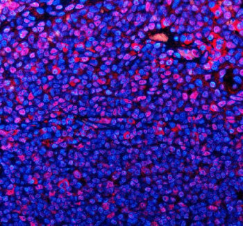 Immunofluorescent staining of TMC6 using anti-TMC6 antibody (red). TMC6 was detected in a paraffin-embedded section of human tonsil tissue. Heat mediated antigen retrieval was performed in EDTA buffer (pH 8.0, epitope retrieval solution). The tissue section was blocked with 10% goat serum. The tissue section was then incubated with 5 ug/ml rabbit anti-TMC6 antibody overnight at 4oC. Cy3 Conjugated Goat Anti-Rabbit IgG was used as secondary antibody at 1:500 dilution and incubated for 30 min at 37oC.