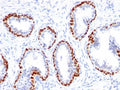 Immunohistochemistry analysis of p63 expression. Recombinant TP63 antibody (clone TMPR63-1R) staining was performed on formalin-fixed, paraffin-embedded human prostate cancer tissue, showing nuclear DAB-positive staining in basal-type epithelial cells lining glandular structures, with surrounding stromal cells largely negative and hematoxylin counterstaining.