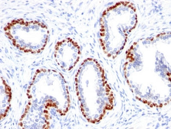 Immunohistochemistry analysis of p63 expression. Recombinant TP63 antibody (clone TMPR63-1R) staining was performed on formalin-fixed, paraffin-embedded human prostate cancer tissue, showing nuclear DAB-positive staining in basal-type epithelial cells lining glandular structures, with surrounding stromal cells largely negative and hematoxylin counterstaining.