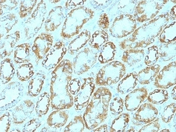 IHC: Formalin-fixed, paraffin-embedded human renal cell carcinoma stained with Laminin gamma 1 antibody (clone A5).