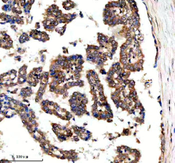 Immunohistochemical staining of SRBD1 using anti-SRBD1 antibody. SRBD1 was detected in a paraffin-embedded section of human lung adenocarcinoma tissue. Heat mediated antigen retrieval was performed in EDTA buffer (pH 8.0, epitope retrieval solution). The tissue section was blocked with 10% goat serum. The tissue section was then incubated with 2 ug/ml rabbit anti-SRBD1 antibody overnight at 4oC. Peroxidase Conjugated Goat Anti-rabbit IgG was used as secondary antibody and incubated for 30 min at 37oC.