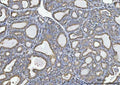 IHC staining of FFPE human thyroiditis tissue with GLDC antibody. HIER: boil tissue sections in pH8 EDTA for 20 min and allow to cool before testing.