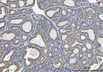 IHC staining of FFPE human thyroiditis tissue with GLDC antibody. HIER: boil tissue sections in pH8 EDTA for 20 min and allow to cool before testing.