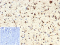 IHC staining of FFPE human brain tissue with IDH1-R132H mutation with IDH1-R132H antibody (clone IDH1.R132H/7328R). Inset: PBS used in place of primary Ab (secondary Ab negative control). HIER: boil tissue sections in pH 9 10mM Tris with 1mM EDTA for 20 min and allow to cool before testing.