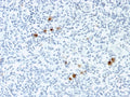IHC staining of FFPE Hodgkin's Lymphoma with EBV antibody (clone CS4). HIER: boil tissue sections in pH 9 10mM Tris with 1mM EDTA for 10-20 min and allow to cool before testing.