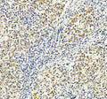 Immunohistochemical staining of FFPE human lymphoma tissue with MALT1 antibody, HRP-secondary and DAB substrate. HIER: boil tissue sections in pH8 EDTA for 20 min and allow to cool before testing.