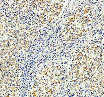 Immunohistochemical staining of FFPE human lymphoma tissue with MALT1 antibody, HRP-secondary and DAB substrate. HIER: boil tissue sections in pH8 EDTA for 20 min and allow to cool before testing.