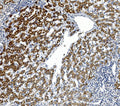 Immunohistochemical staining of GPNMB using anti-GPNMB antibody. GPNMB was detected in paraffin-embedded section of human liver cancer. Heat mediated antigen retrieval was performed in EDTA buffer (pH 8.0, epitope retrieval solution). The tissue section was blocked with 10% goat serum. The tissue section was then incubated with 1ug/ml rabbit anti-GPNMB antibody overnight at 4oC. Biotinylated goat anti-rabbit IgG was used as secondary antibody and incubated for 30 min at 37oC.
