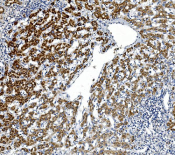 Immunohistochemical staining of GPNMB using anti-GPNMB antibody. GPNMB was detected in paraffin-embedded section of human liver cancer. Heat mediated antigen retrieval was performed in EDTA buffer (pH 8.0, epitope retrieval solution). The tissue section was blocked with 10% goat serum. The tissue section was then incubated with 1ug/ml rabbit anti-GPNMB antibody overnight at 4oC. Biotinylated goat anti-rabbit IgG was used as secondary antibody and incubated for 30 min at 37oC.