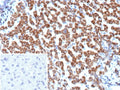 IHC staining of FFPE human hepatocellular carcinoma tissue with Angiopoietin 1 antibody (clone ANGPT1/3651). Inset: PBS used in place of primary Ab (secondary Ab negative control). HIER: boil tissue sections in pH 9 10mM Tris with 1mM EDTA for 20 min and allow to cool before testing.